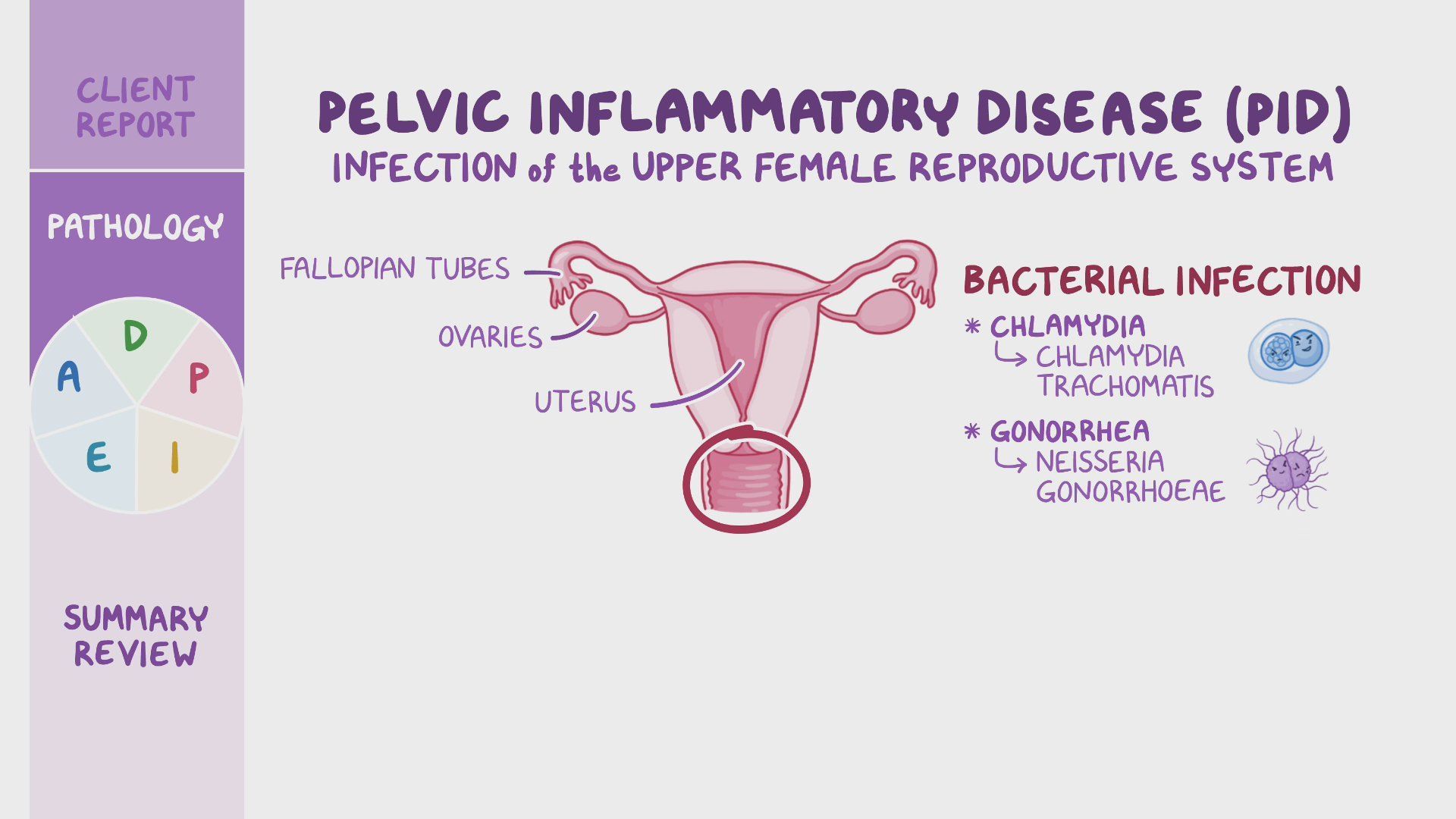 Video Pelvic Inflammatory Disease PID Nursing Process ADPIE Osmosis Video Pelvic Inflammatory Disease PID Nursing Process ADPIE Osmosis