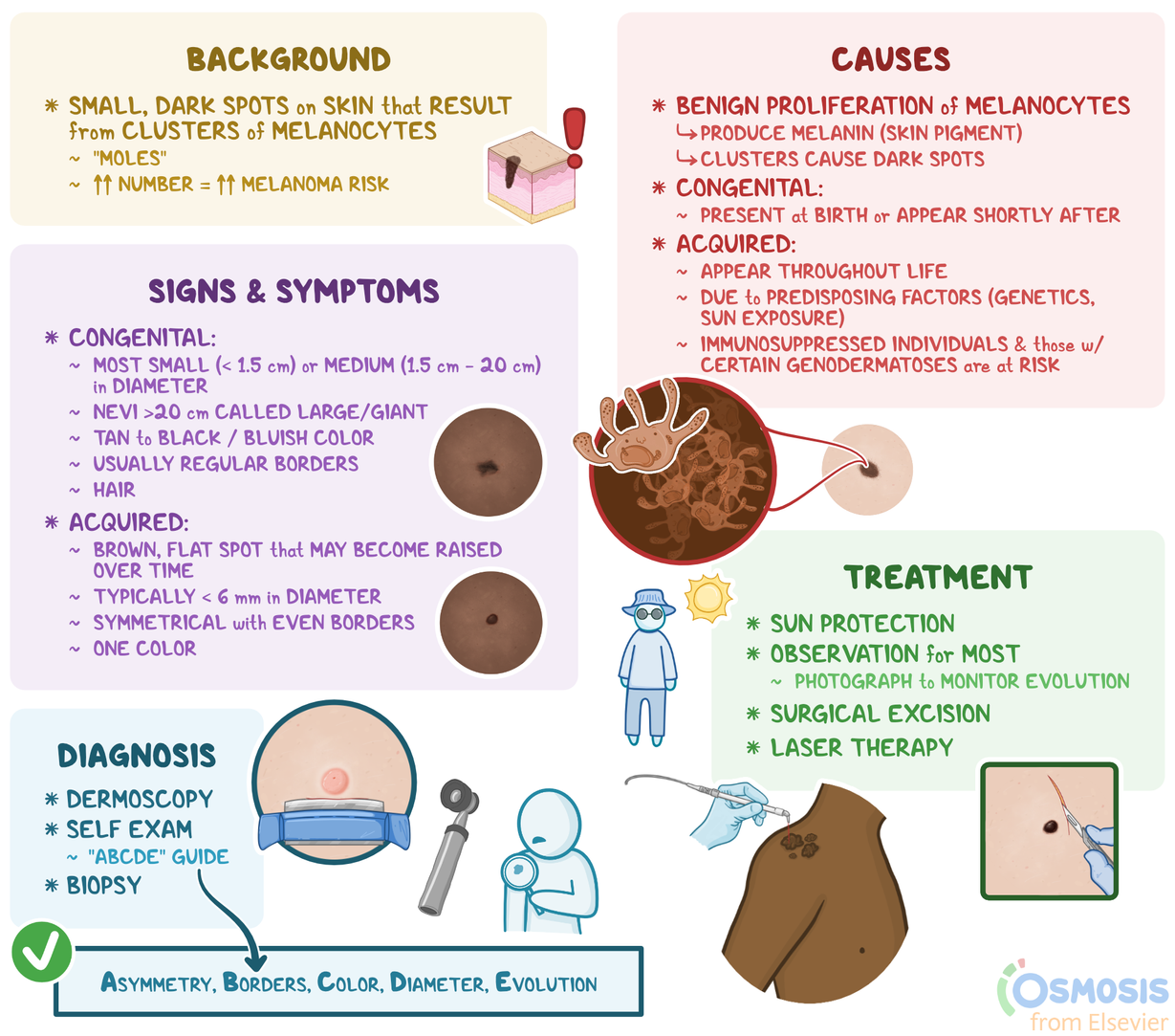 Melanocytic Nevus: What Is It, Causes, Signs and Symptoms, and More |  Osmosis