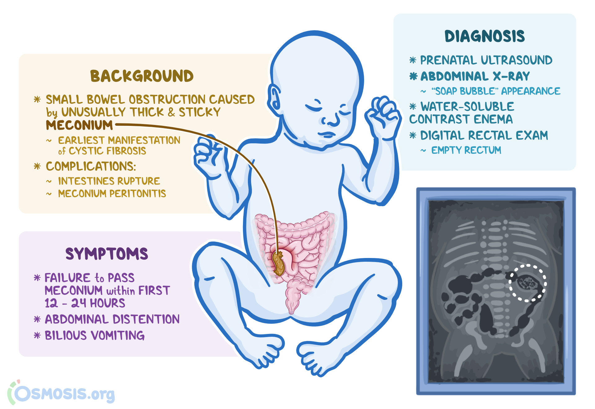Meconium Ileus Failure To Pass Meconium Diagnosing Neonatal