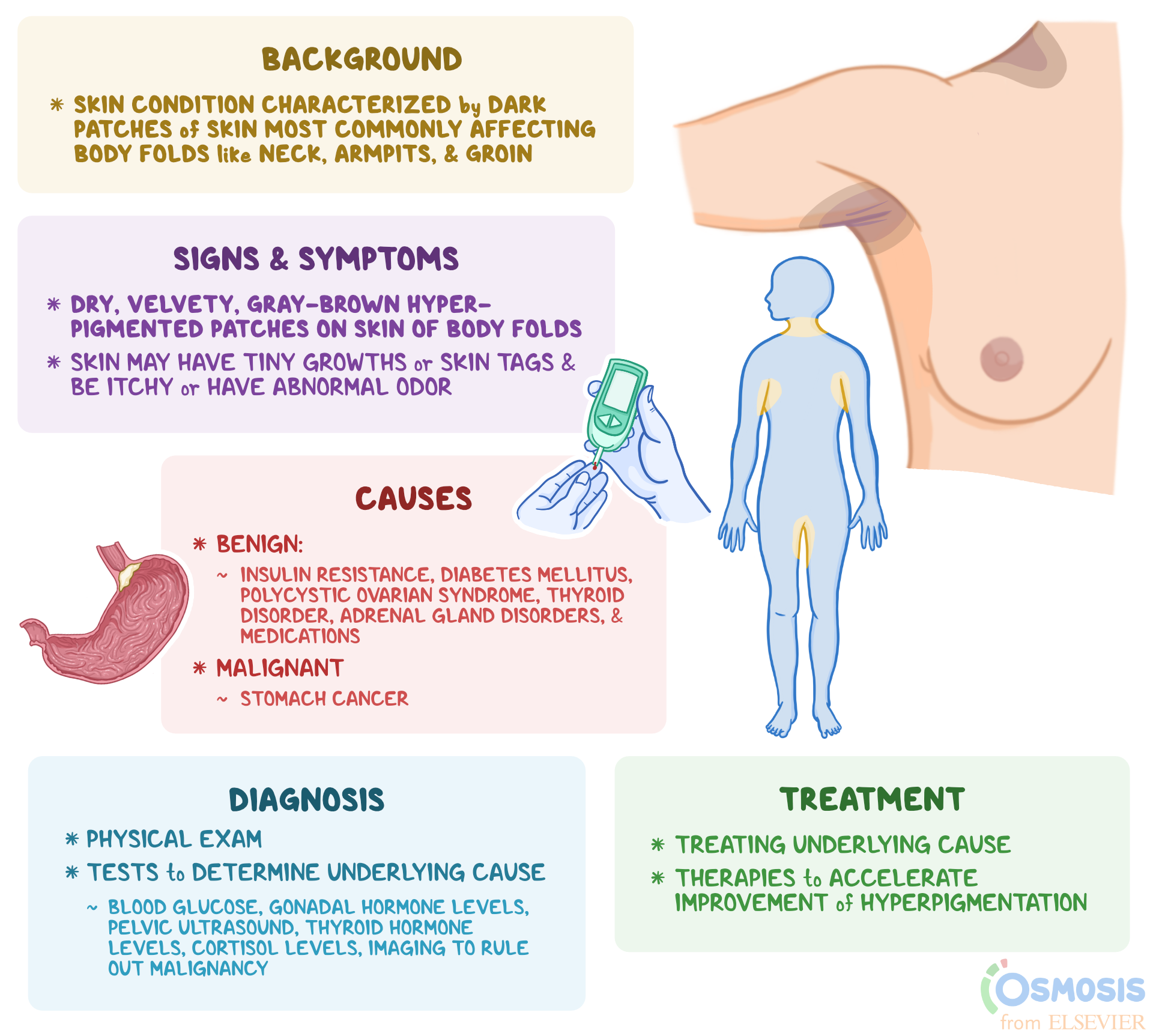 Acanthosis Nigricans What Is It Causes Signs And 41 OFF