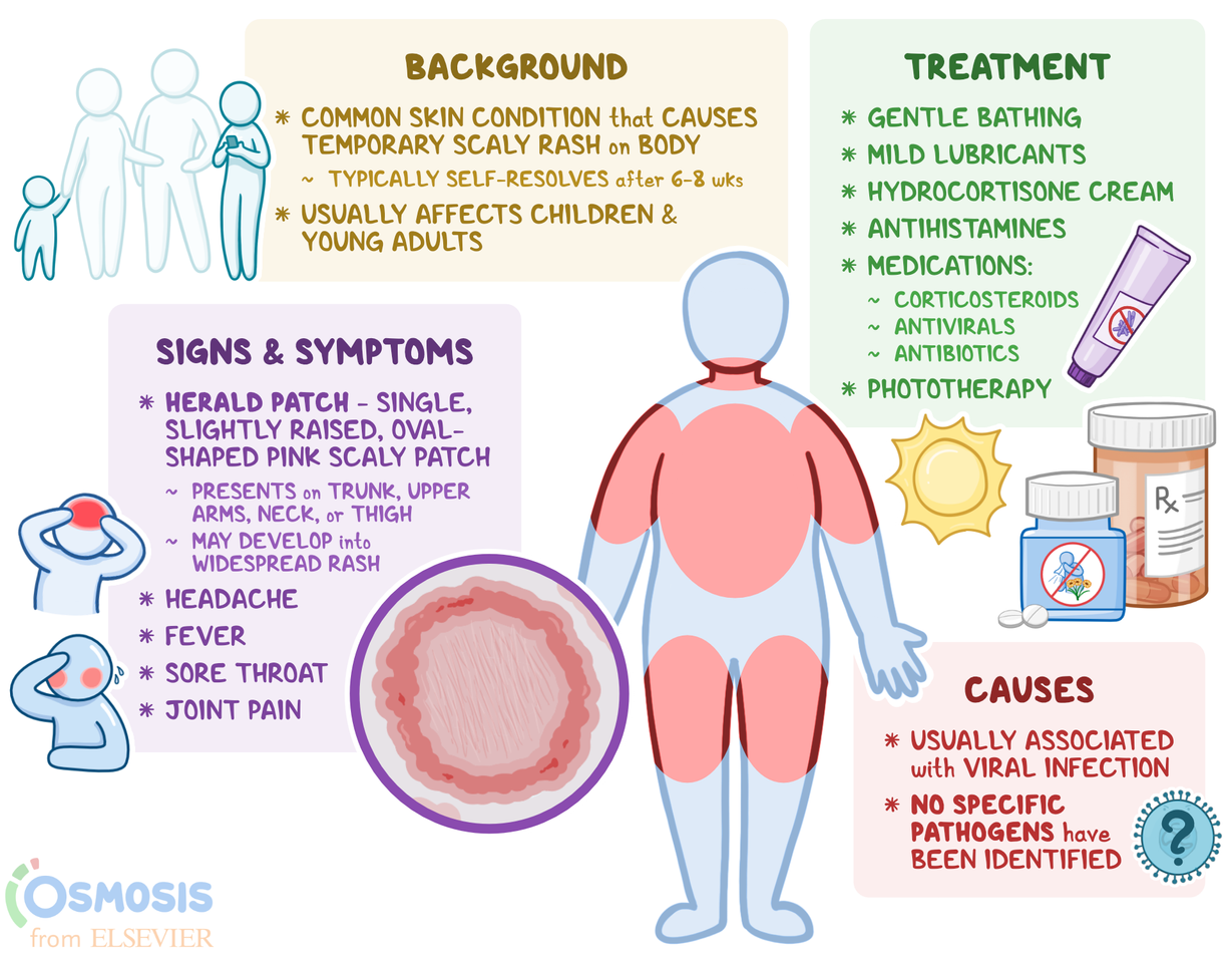 Pityriasis Rosea Treatment Guidelines TVHG