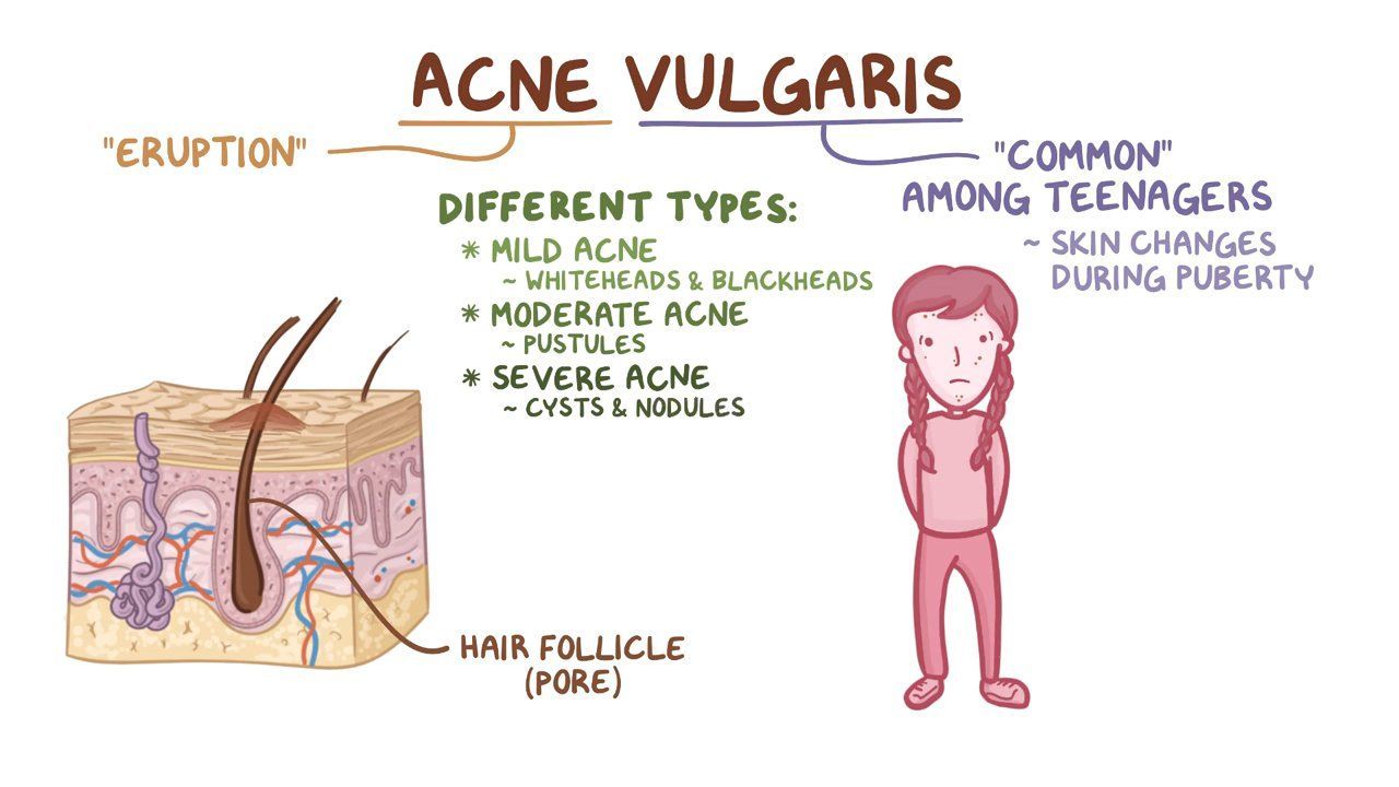 Pathophysiology Of Acne