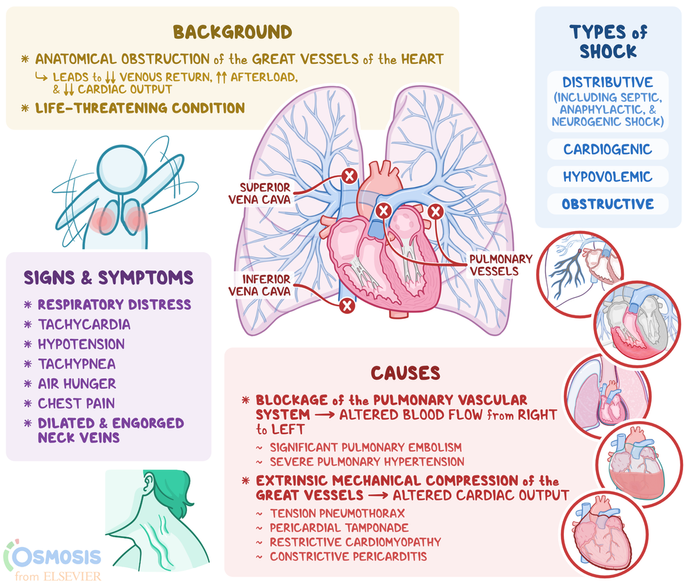 Obstructive Shock What Is It Causes Diagnosis And More Osmosis