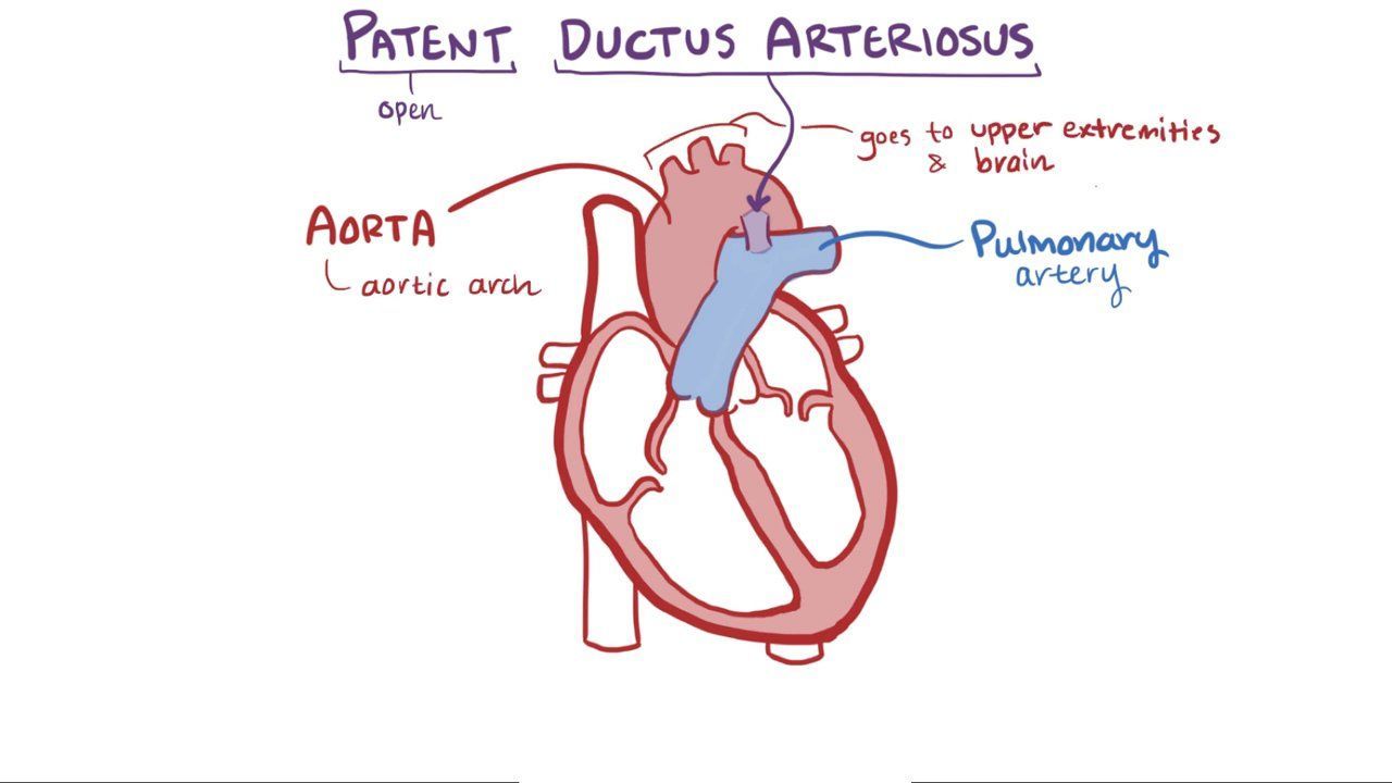 Video Patent Ductus Arteriosus Osmosis
