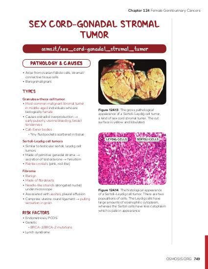 Chapter 124 Female Genitourinary Cancers SEX CORD-GONADAL STROMAL TUMOR osms.it/sex_cord-gonadal_stromal_tumor PATHOLOGY & CAUSES ▪ Arise from ovarian follicle cells, stromal/ connective tissue cells ▪ Benign/malignant TYPES Granulosa-theca cell tumor ▪ Most common malignant stromal tumor in middle-aged individuals who are biologically female ▪ Causes estradiol overproduction → early puberty, uterine bleeding, breast tenderness ▪ Call–Exner bodies ▫ Tiny fluid pockets scattered in tissue Figure 124.13 The gross pathological appearance of a Sertoli–Leydig cell tumor, a kind of sex cord stromal tumor. The cut surface is yellow and lobulated. Sertoli-Leydig cell tumors ▪ Similar to testicular sertoli, Leydig cell tumors ▪ Made of primitive gonadal stroma → secretion of testosterone → hirsutism ▪ Reinke crystals (pink, rod-like) Fibroma ▪ Benign ▪ Made of fibroblasts ▪ Needle-like strands (elongated nuclei) under microscope ▪ Associated with ascites, pleural effusion ▪ Compress uterine round ligament → pulling sensation in groin RISK FACTORS Figure 124.14 The histological appearance of a Sertoli–Leydig cell tumor. There are two popualtions of cells. The Leydig cells have large amounts of eosinophilic cytoplasm, whereas the Sertoli cells have less cytoplasm which is pale in appearance. ▪ Endometriosis, PCOS ▪ Genetic ▫ BRCA-1/BRCA-2 mutations ▪ Lynch syndrome OSMOSIS.ORG 749
