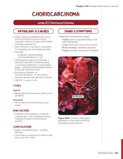 choriocarcinoma gross image