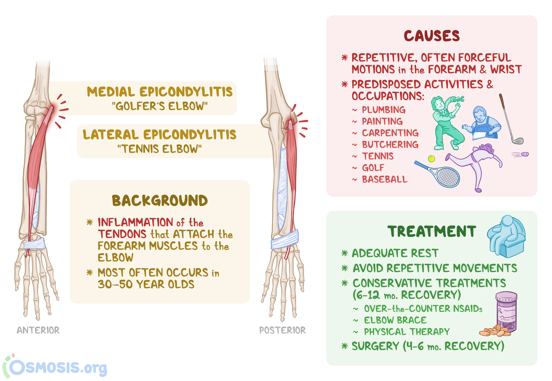 Elbow Pain Lateral Epicondylitis Treatment At Patricia Bartholomew Blog