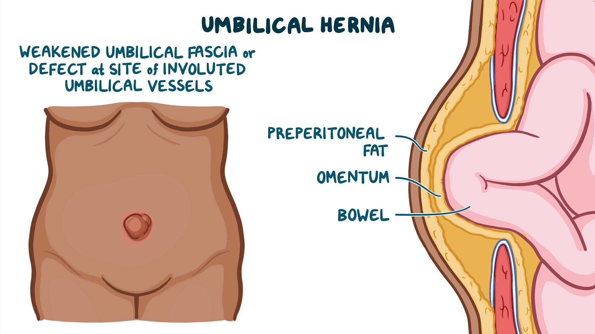 Video Umbilical Hernias Clinical Sciences Osmosis Video Umbilical Hernias Clinical Sciences Osmosis