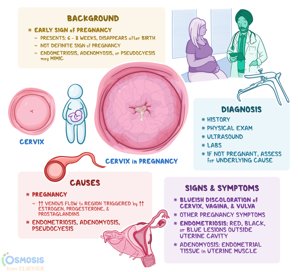 Hegar Sign What Is It Causes And More Osmosis 51 OFF
