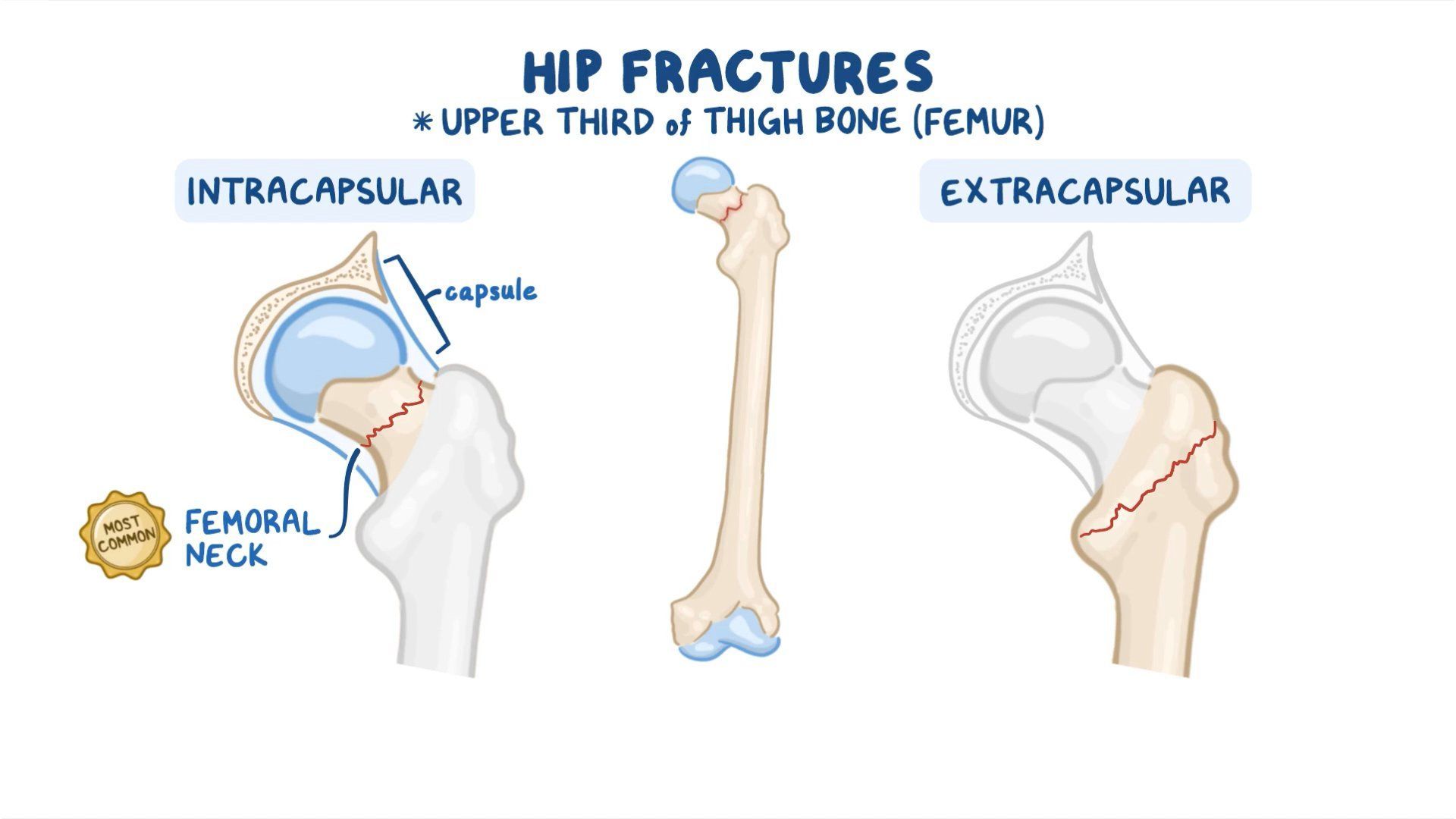 Video Hip Fractures Nursing Osmosis