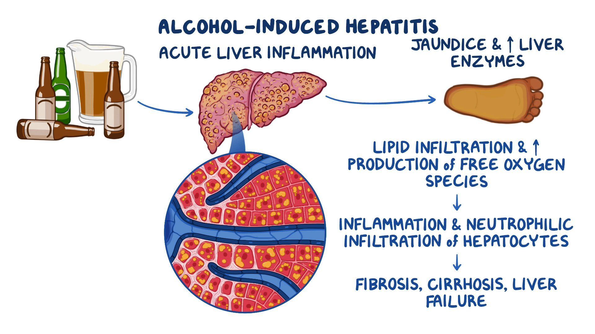 DHM Can Be Used To Treat Alcohol-Induced Liver Damage DHM Can Be Used To Treat Alcohol-Induced Liver Damage