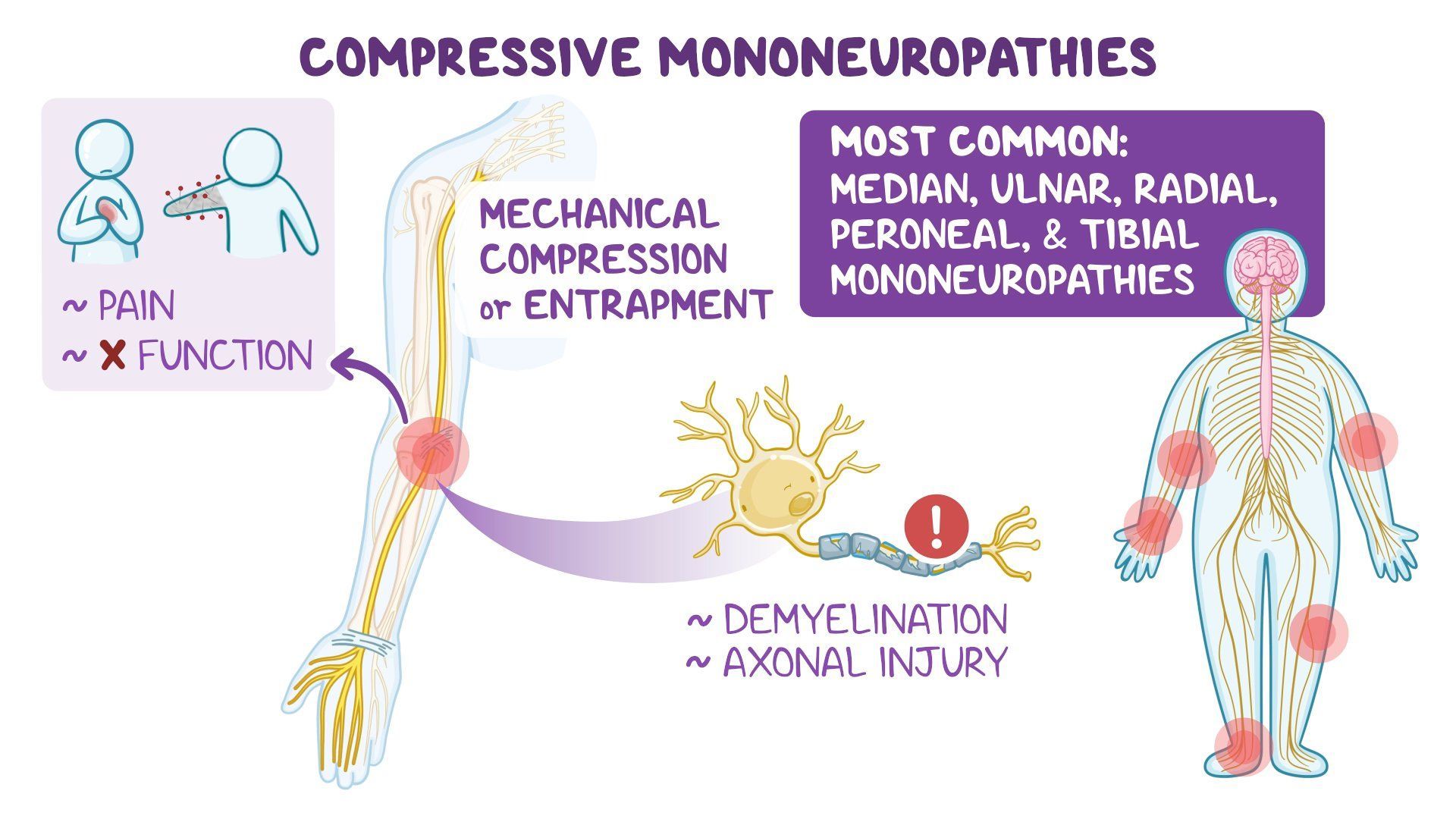 Approach to compressive mononeuropathies: Video & Meaning