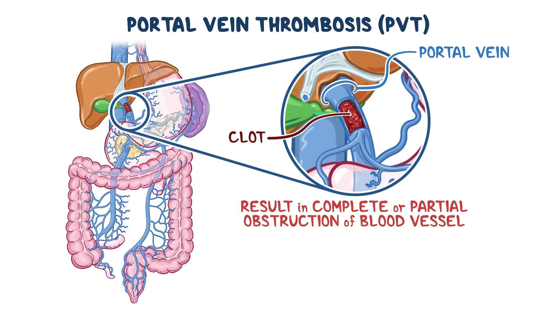 Video portal vein thrombosis clinical sciences