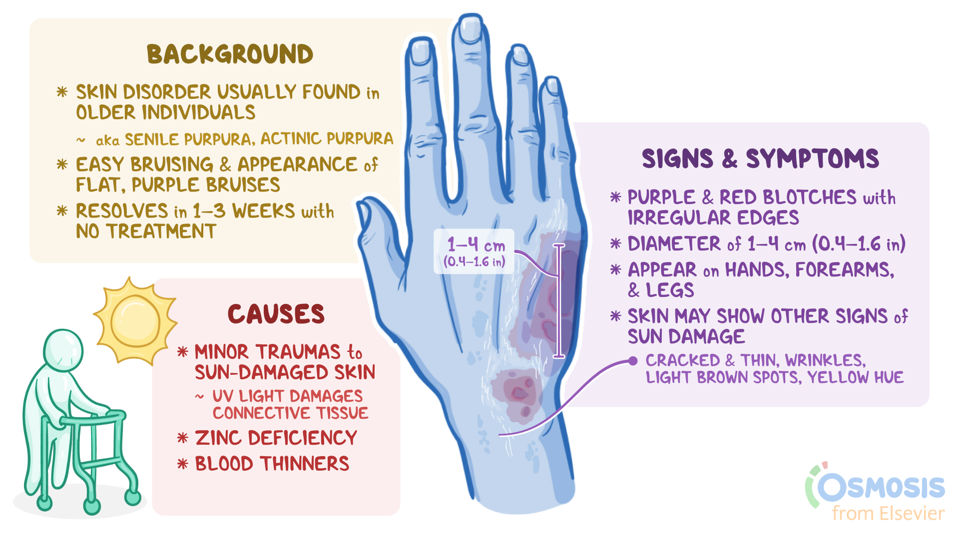 Infographic on senile (actinic) purpura showing background, signs & symptoms, causes, and a hand illustration with purple bruises.