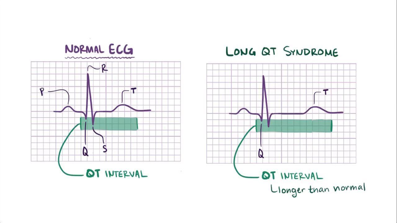 tirzepatide qt prolongation Video: Long QT syndrome and Torsade de pointes