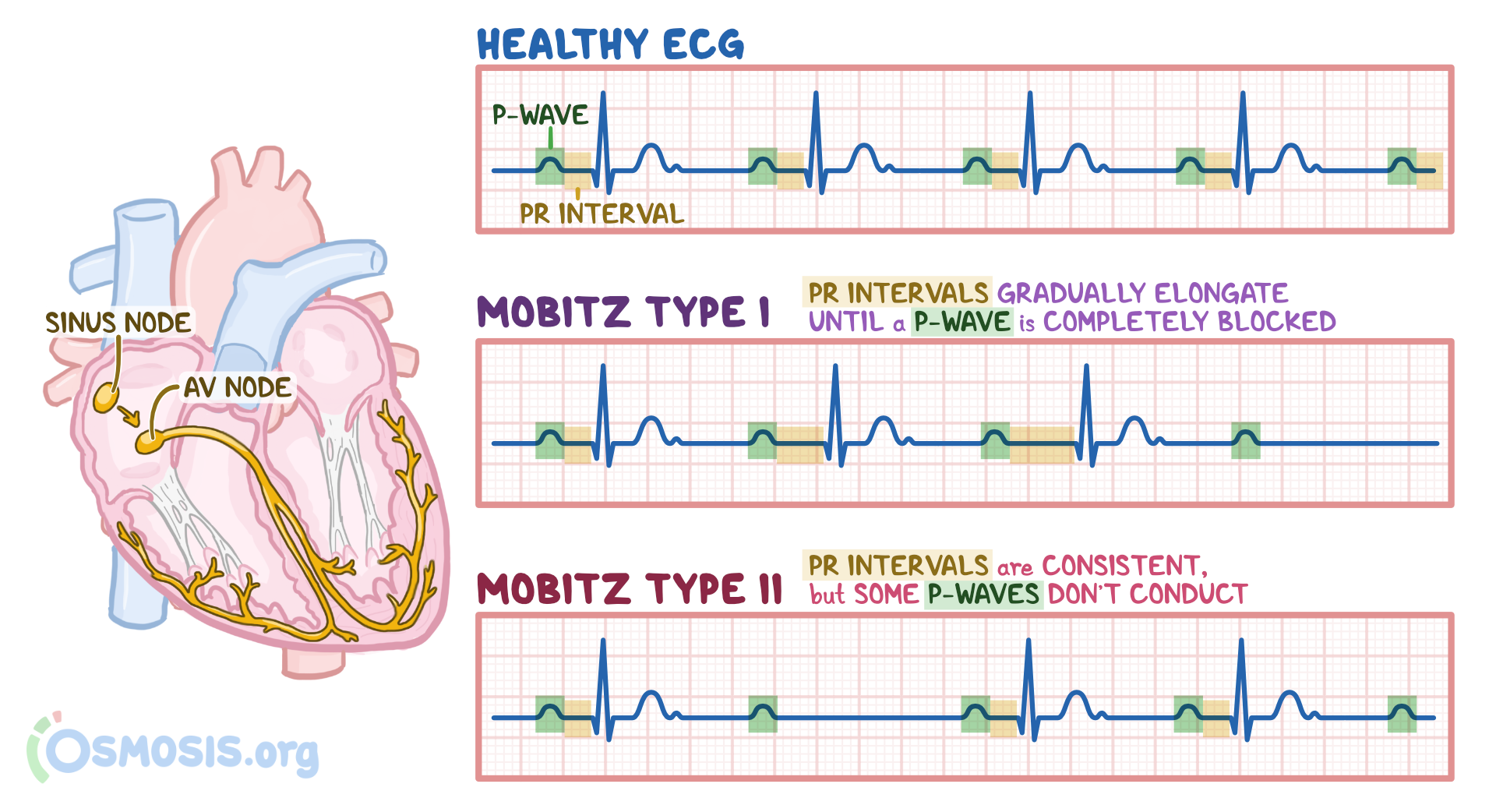 Significance Of Firstdegree Atrioventricular Block In Significance Of Firstdegree Atrioventricular Block In