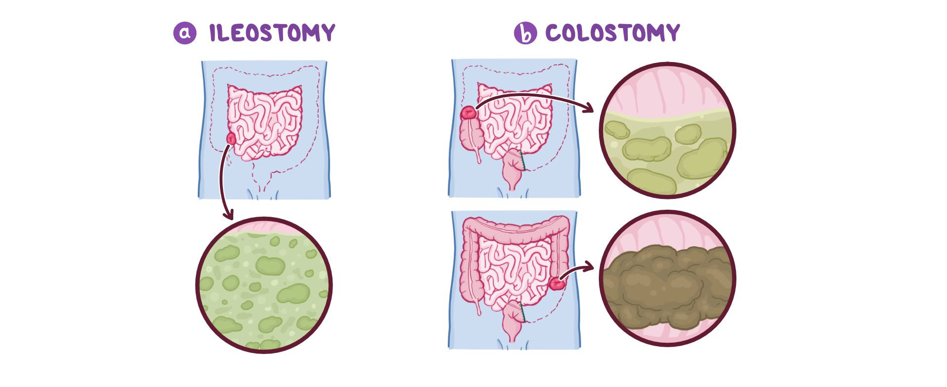 Ileostomy Vs Colostomy