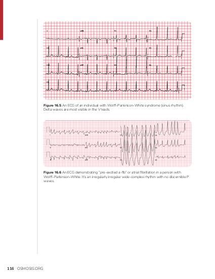 Atrioventricular nodal reentrant tachycardia (AVNRT) | Osmosis