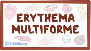 Video poster for Erythema multiforme