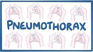 Video poster for Pneumothorax