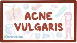 Video poster for Acne vulgaris