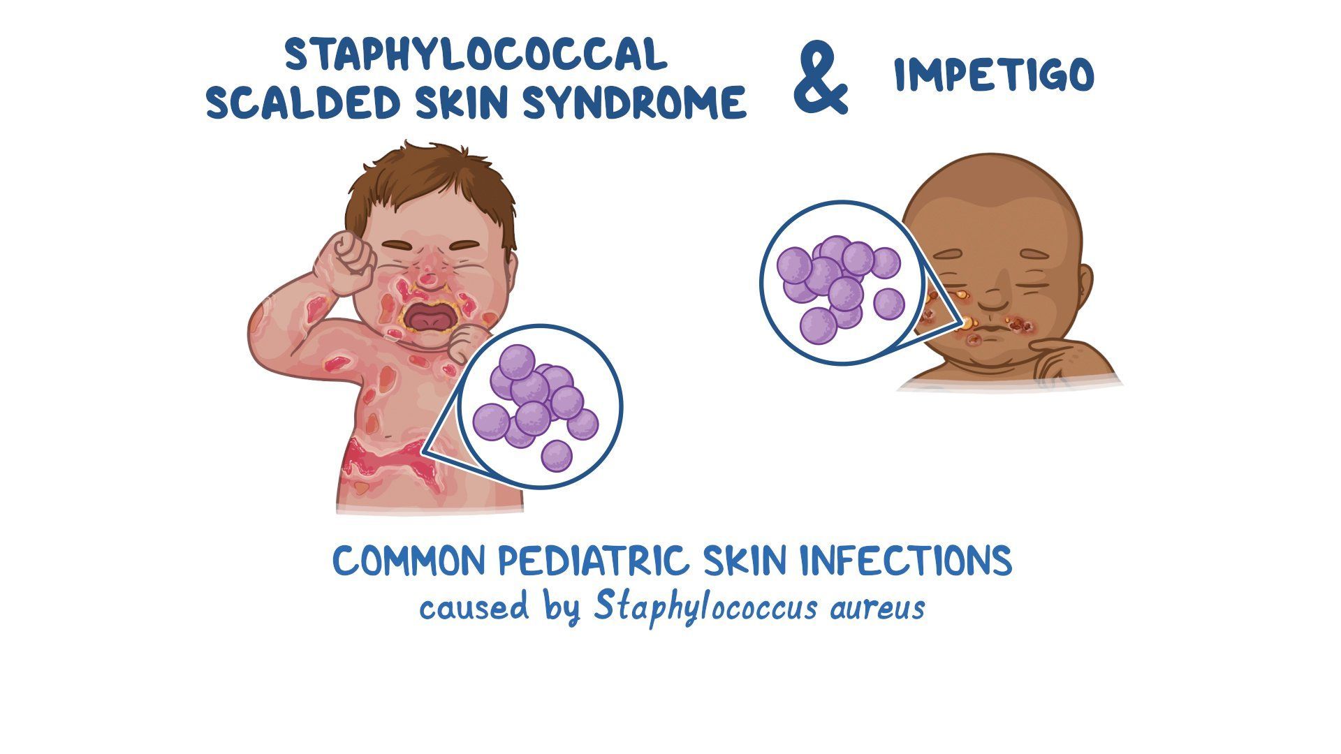 Video Staphylococcal Scalded Skin Syndrome And Impetigo Clinical 