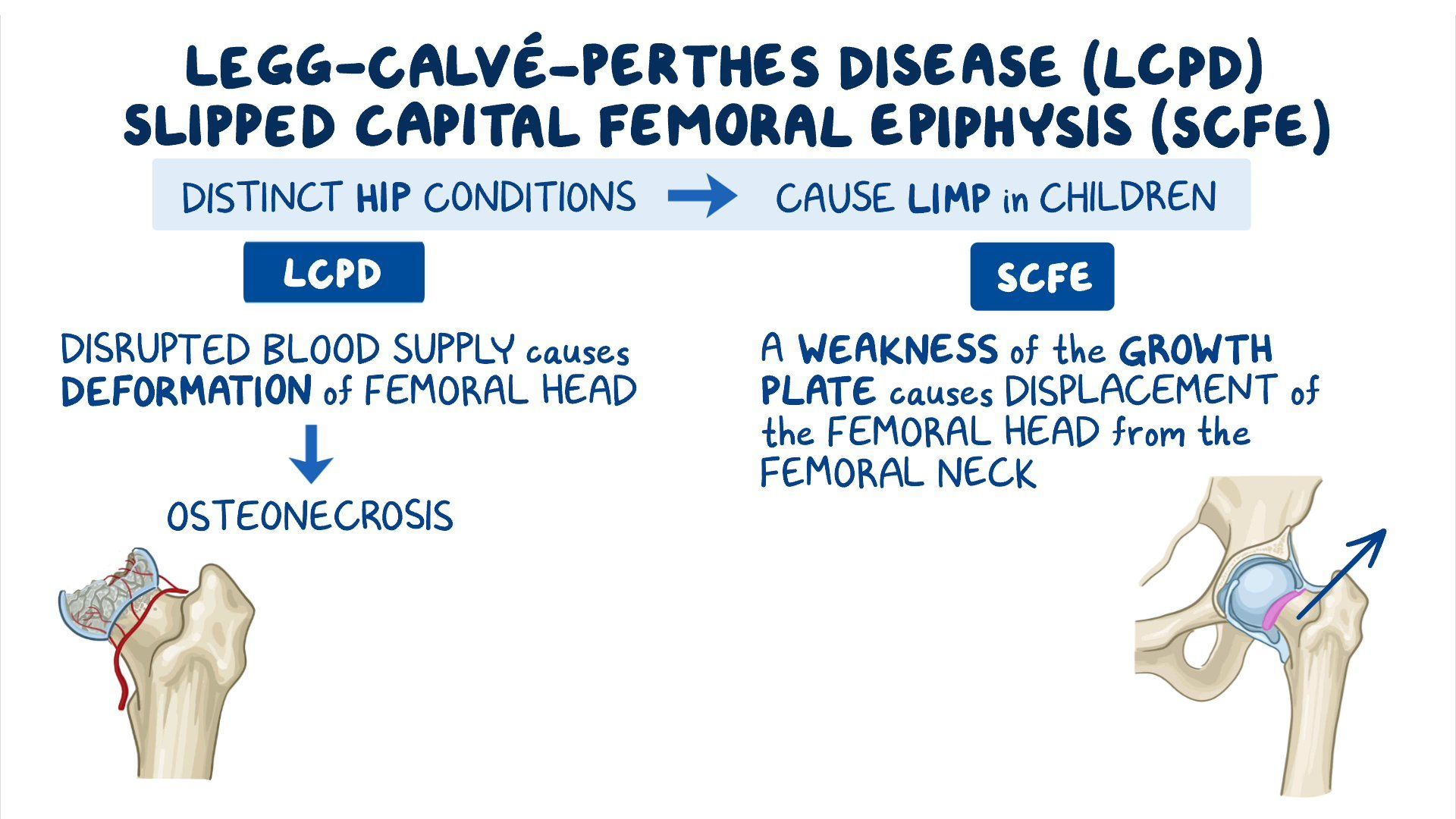 Video: Legg-Calve-Perthes disease and slipped capital femoral epiphysis:  Clinical sciences | Osmosis, image size:1920x1080