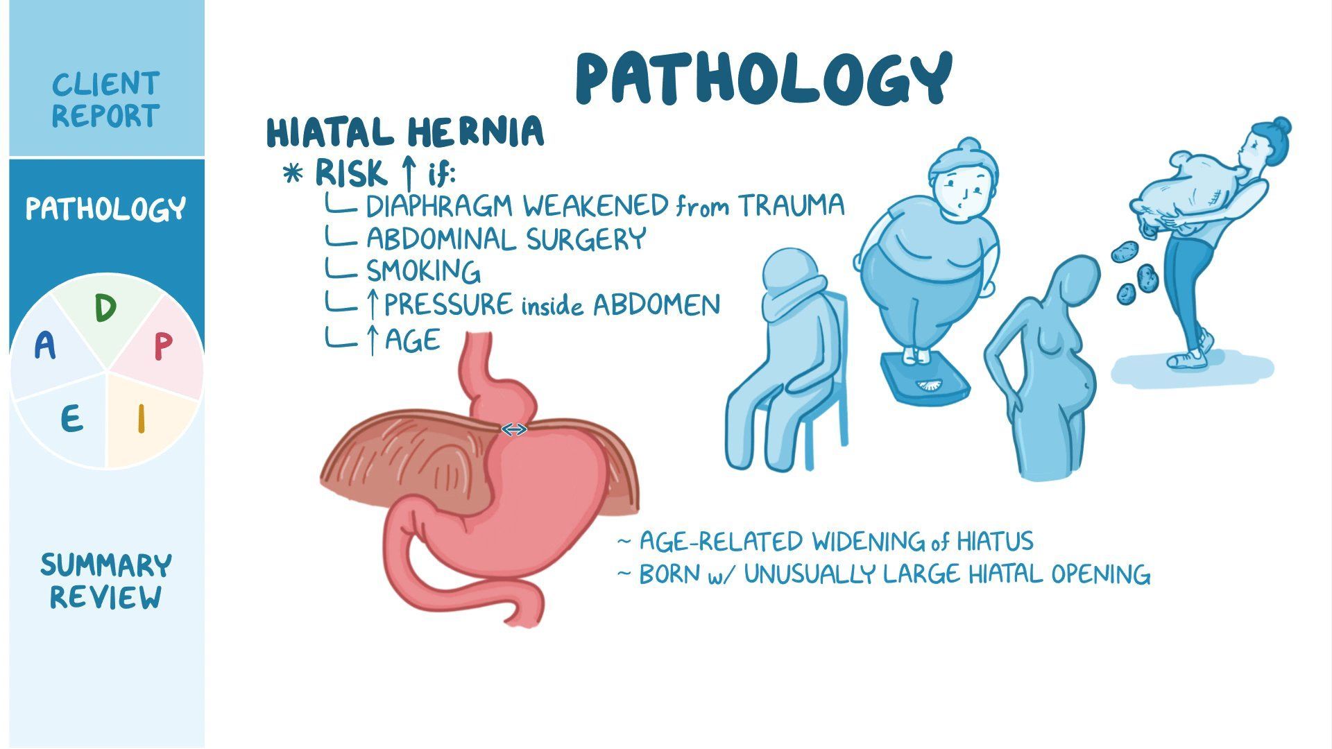 video-hiatal-hernia-nursing-process-adpie-osmosis