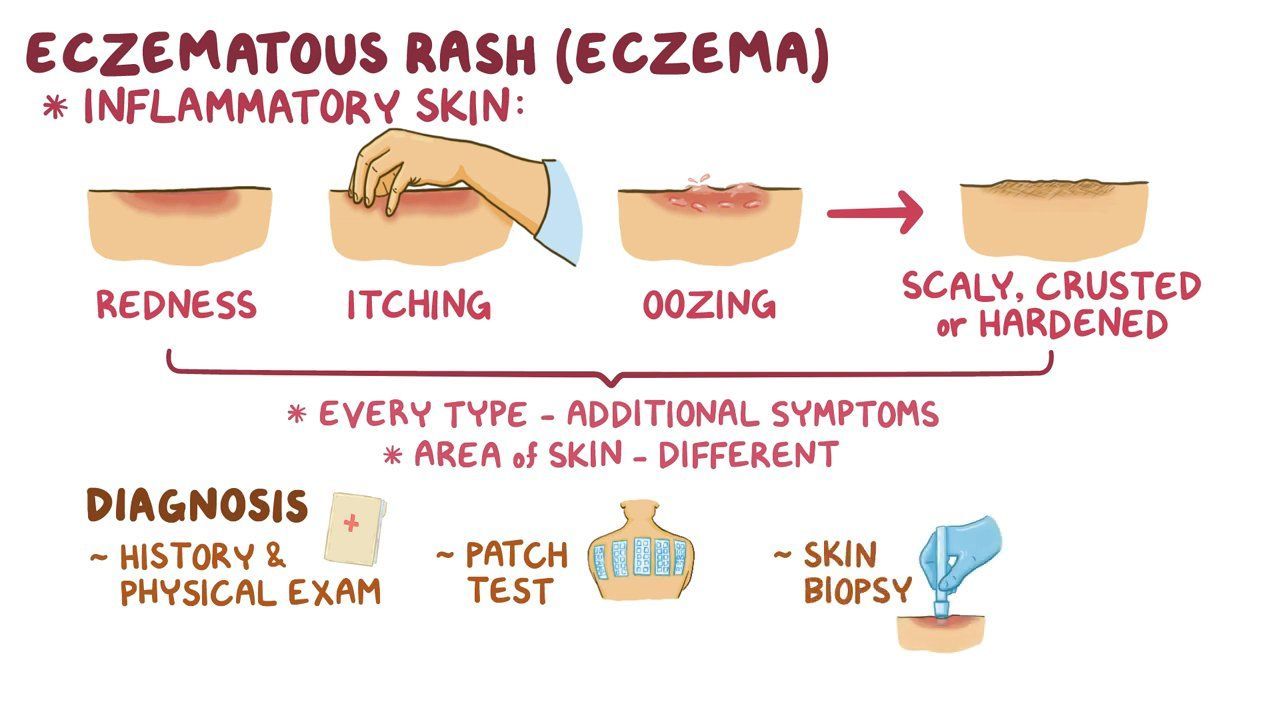 Eczematous rashes Clinical practice Osmosis