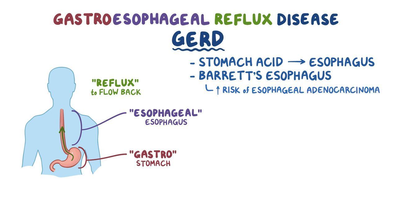 Sandifer Syndrome What Is It Causes Diagnosis And More Osmosis