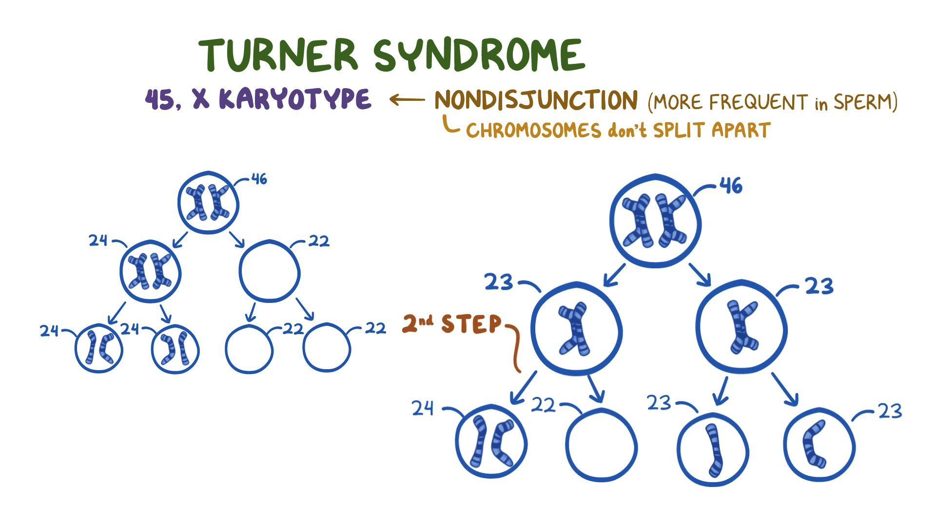 Turner Syndrome Genetic Diagram Turner Syndrome Genetic Diagram