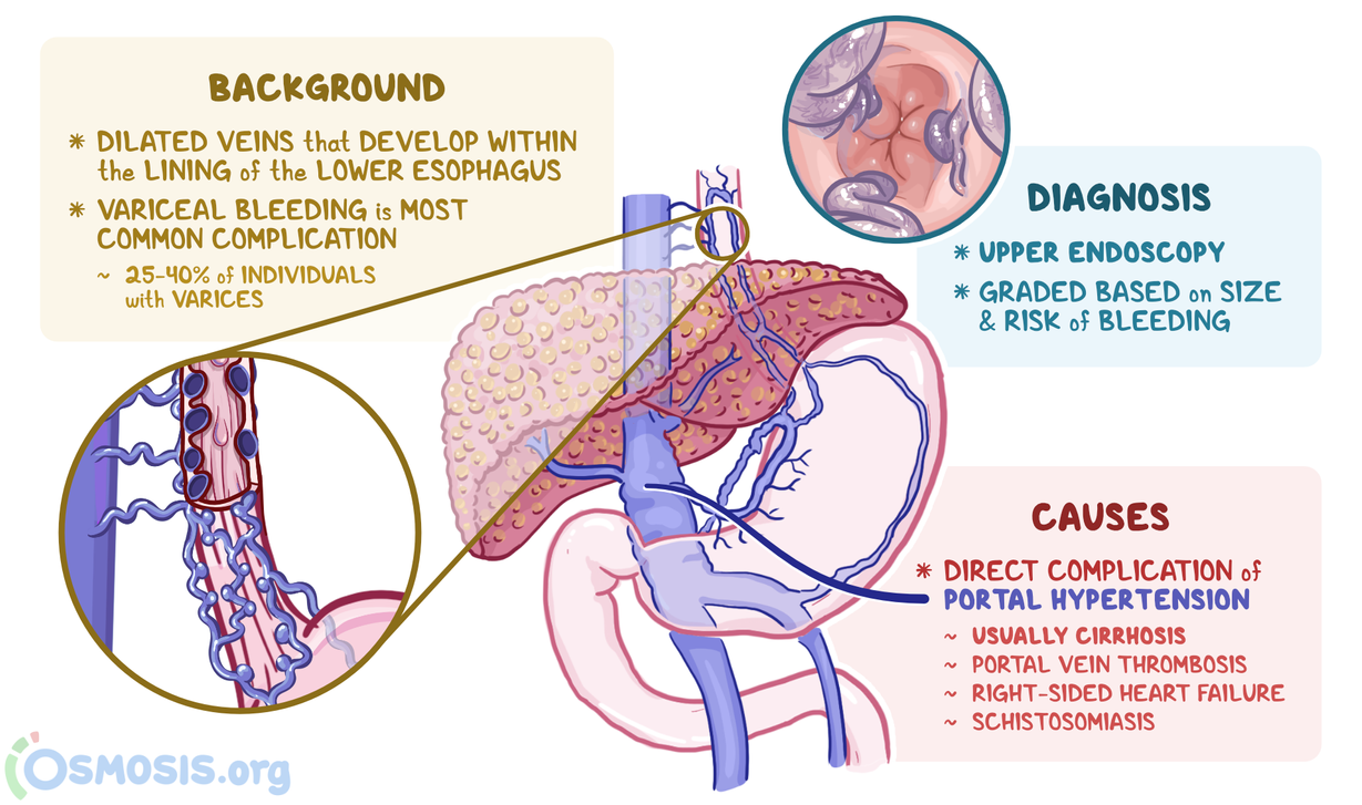 Esophageal Varices What Are They Causes And More Osmosis