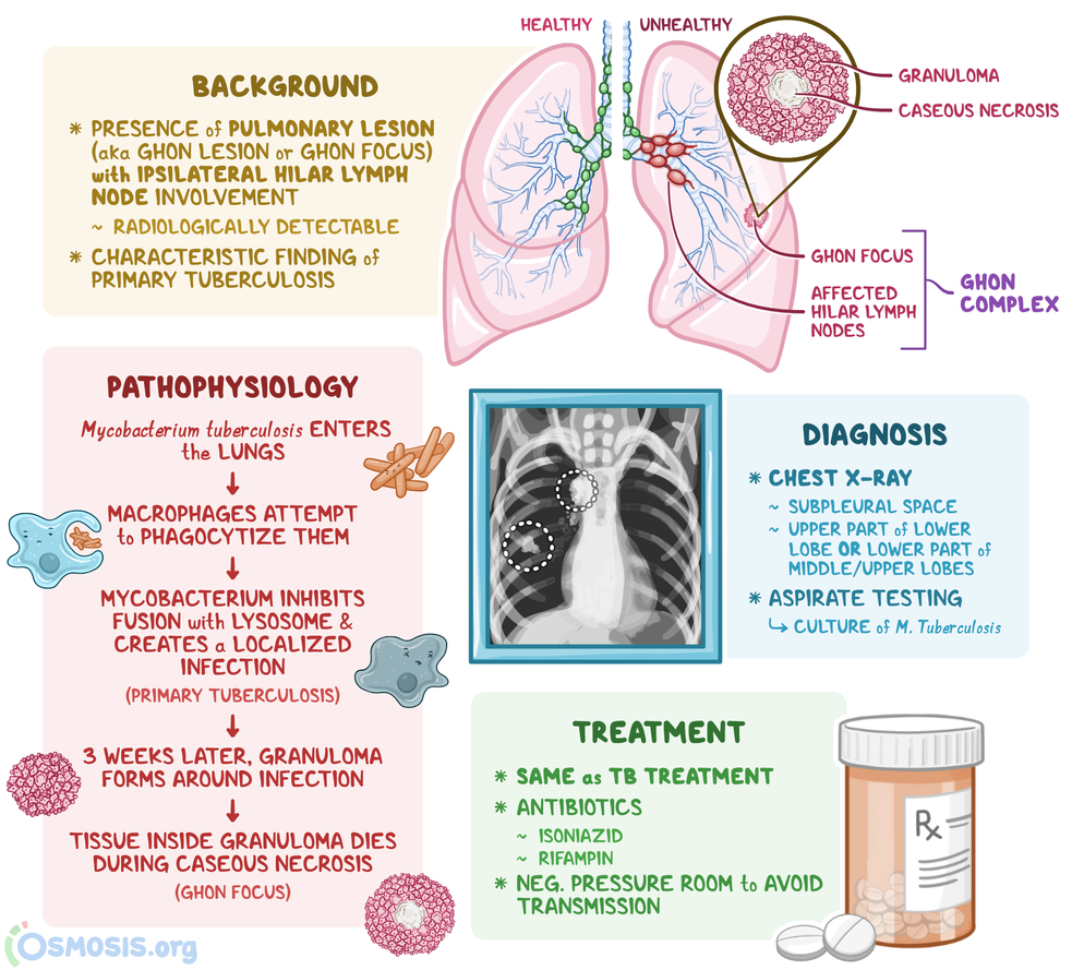 Ghon Complex What Is It Causes Diagnosis Treatment And More Osmosis