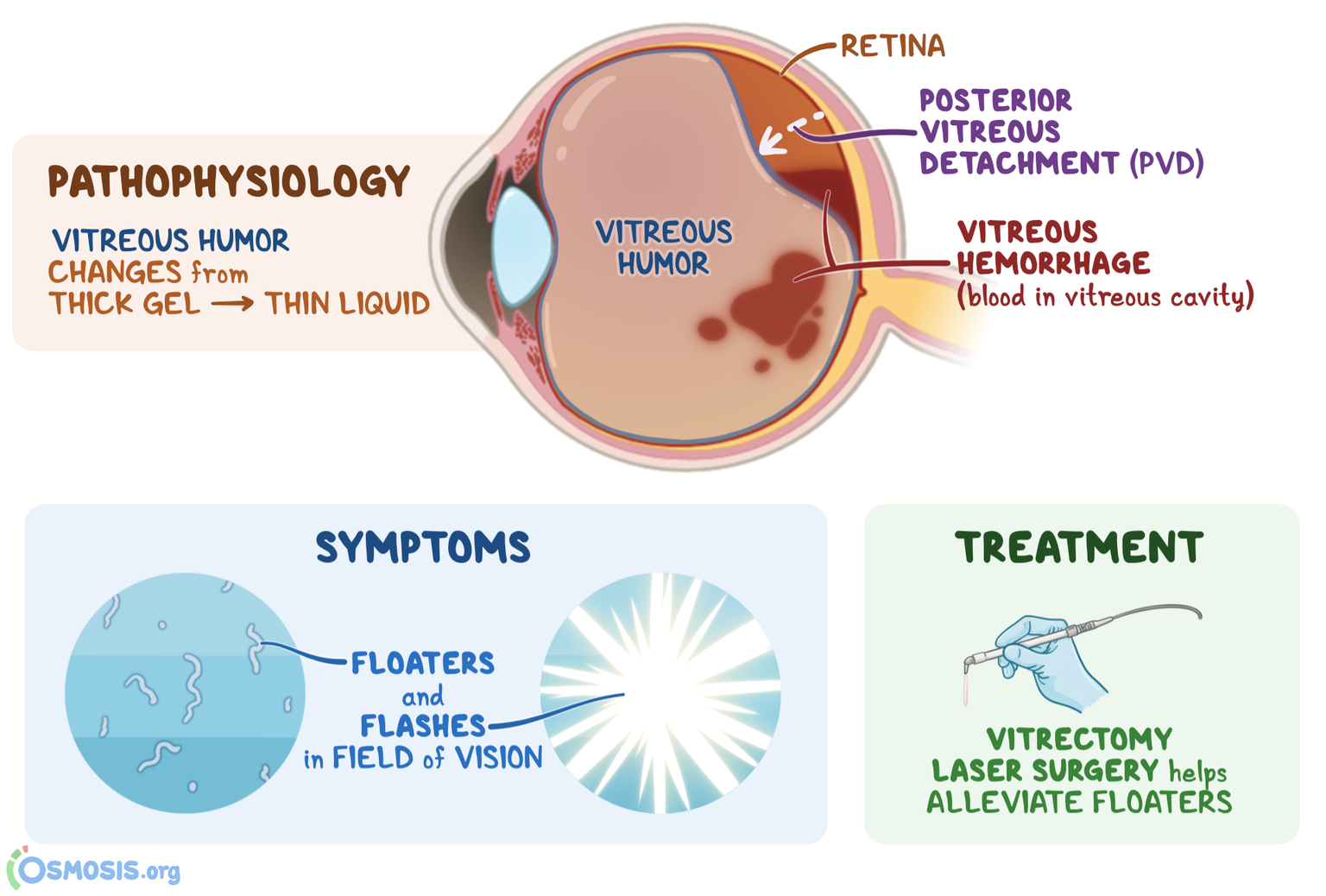 Vitreous Degeneration What Is It Causes Severity Treatment And More