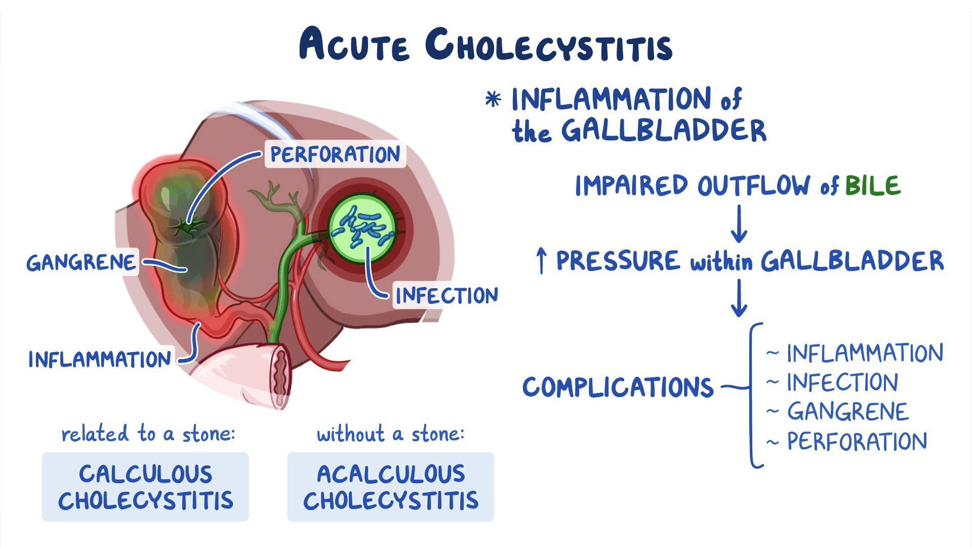 Video cholecystitis clinical sciences osmosis