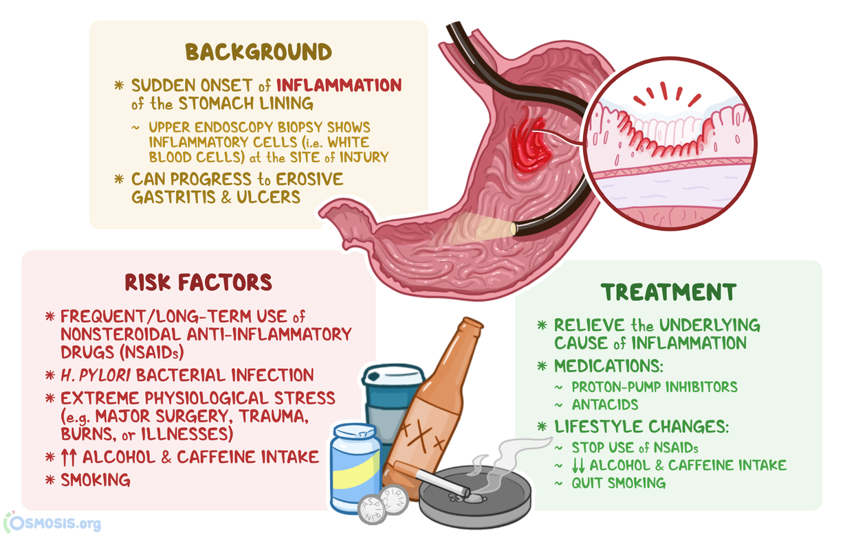 Acute Gastritis What Is It Causes Symptoms Diagnosis And More 