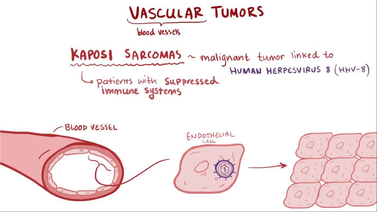Video Vascular tumors