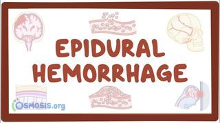 Video poster for Epidural hematoma