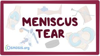 Video poster for Meniscus tear