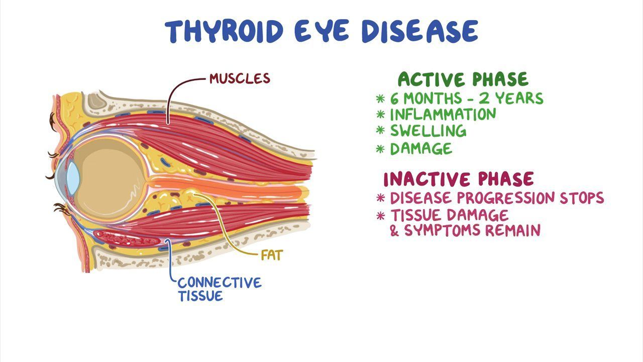 Thyroid eye disease (NORD) Osmosis