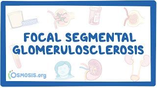 Video poster for Focal Segmental Glomerulosclerosis