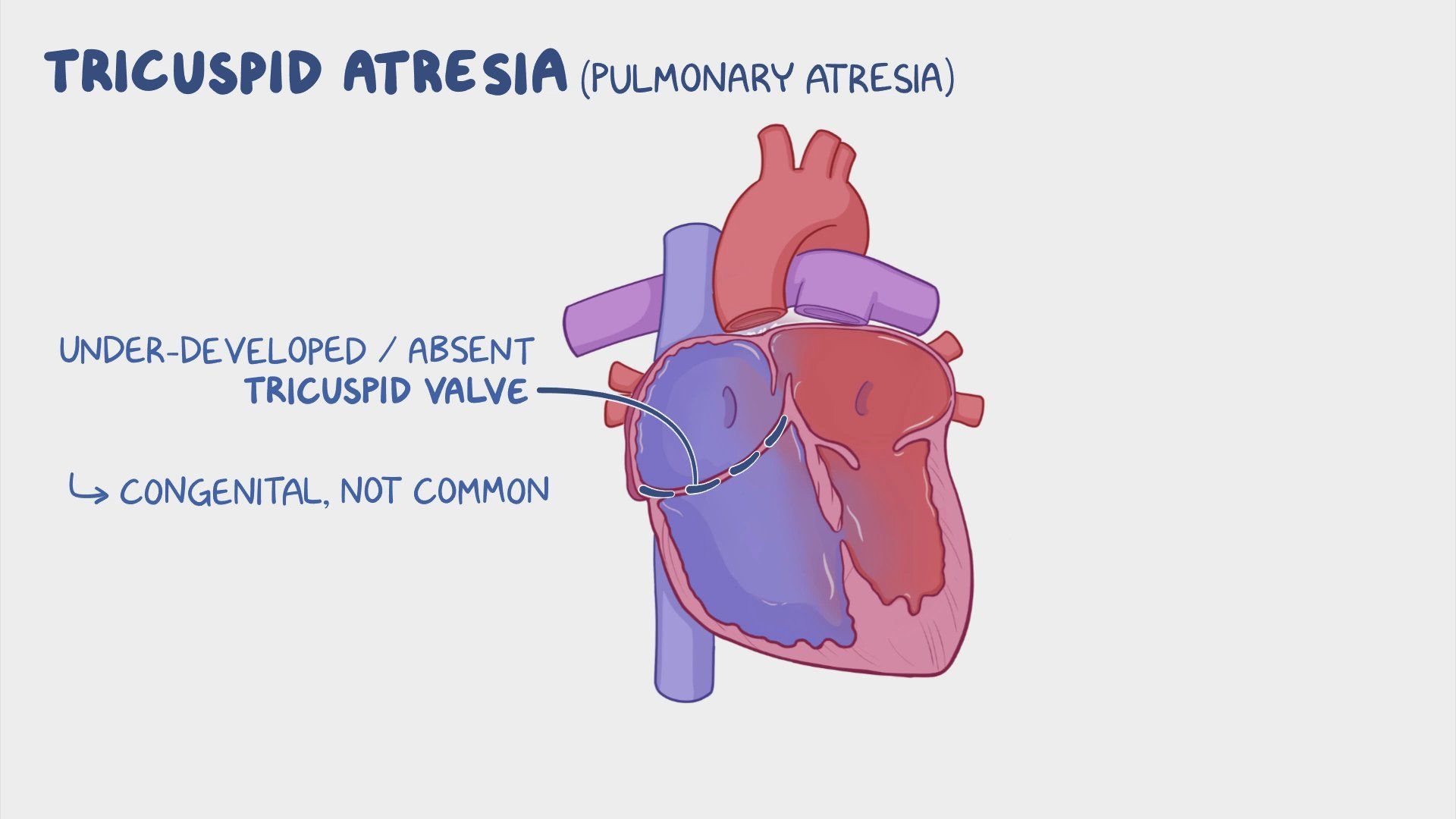 Video: Tricuspid atresia: Nursing | Osmosis
