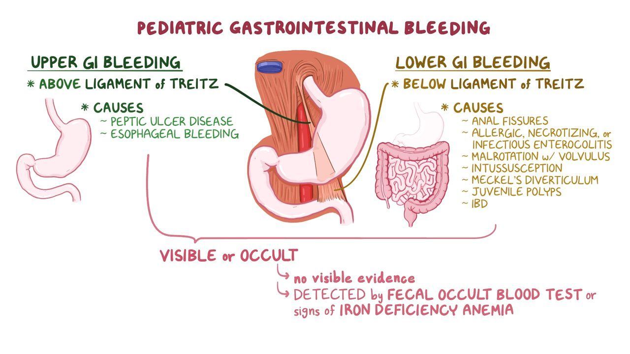 Pediatric gastrointestinal bleeding Clinical practice Osmosis