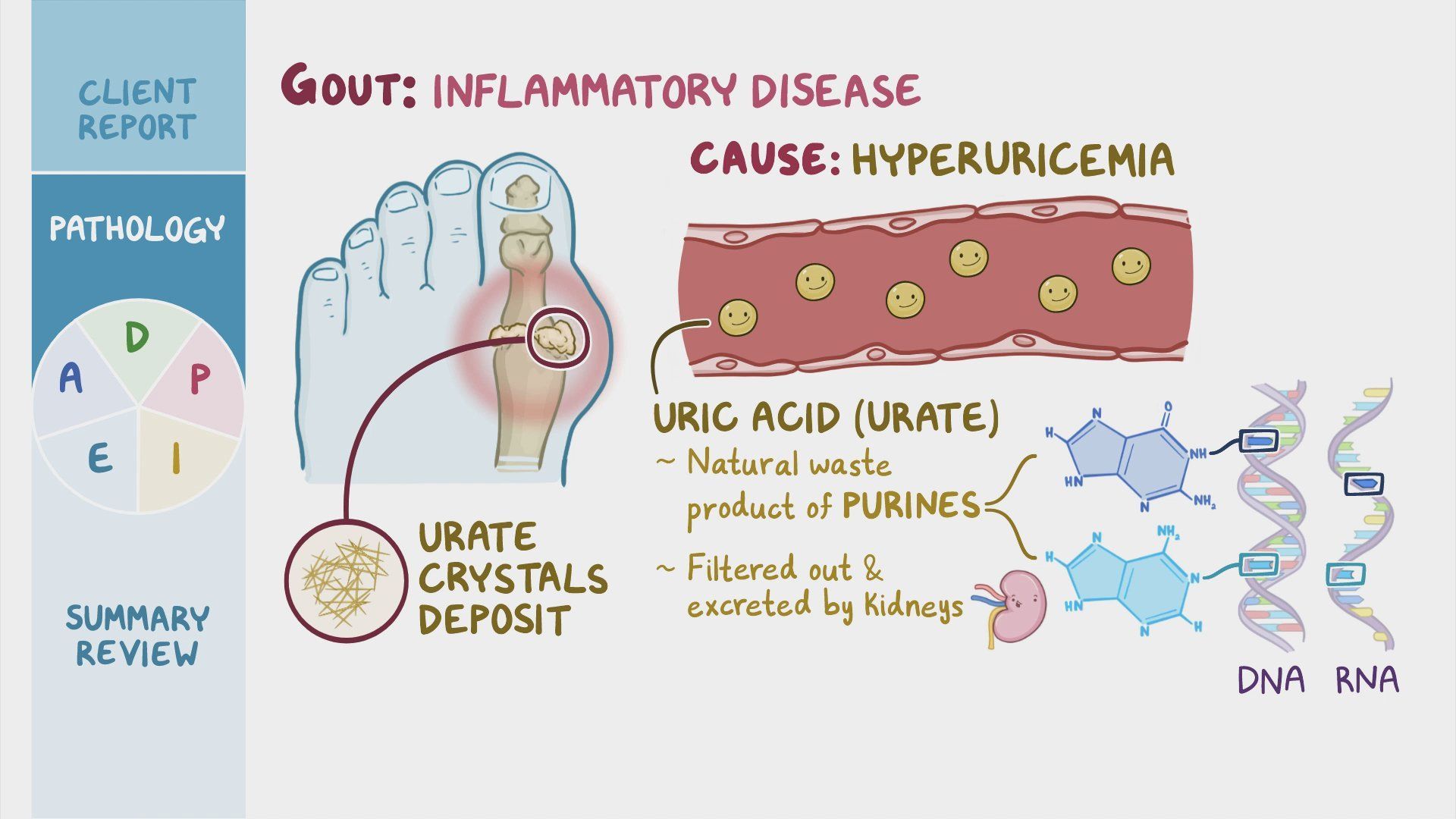 Video: Gout: Nursing process (ADPIE) | Osmosis
