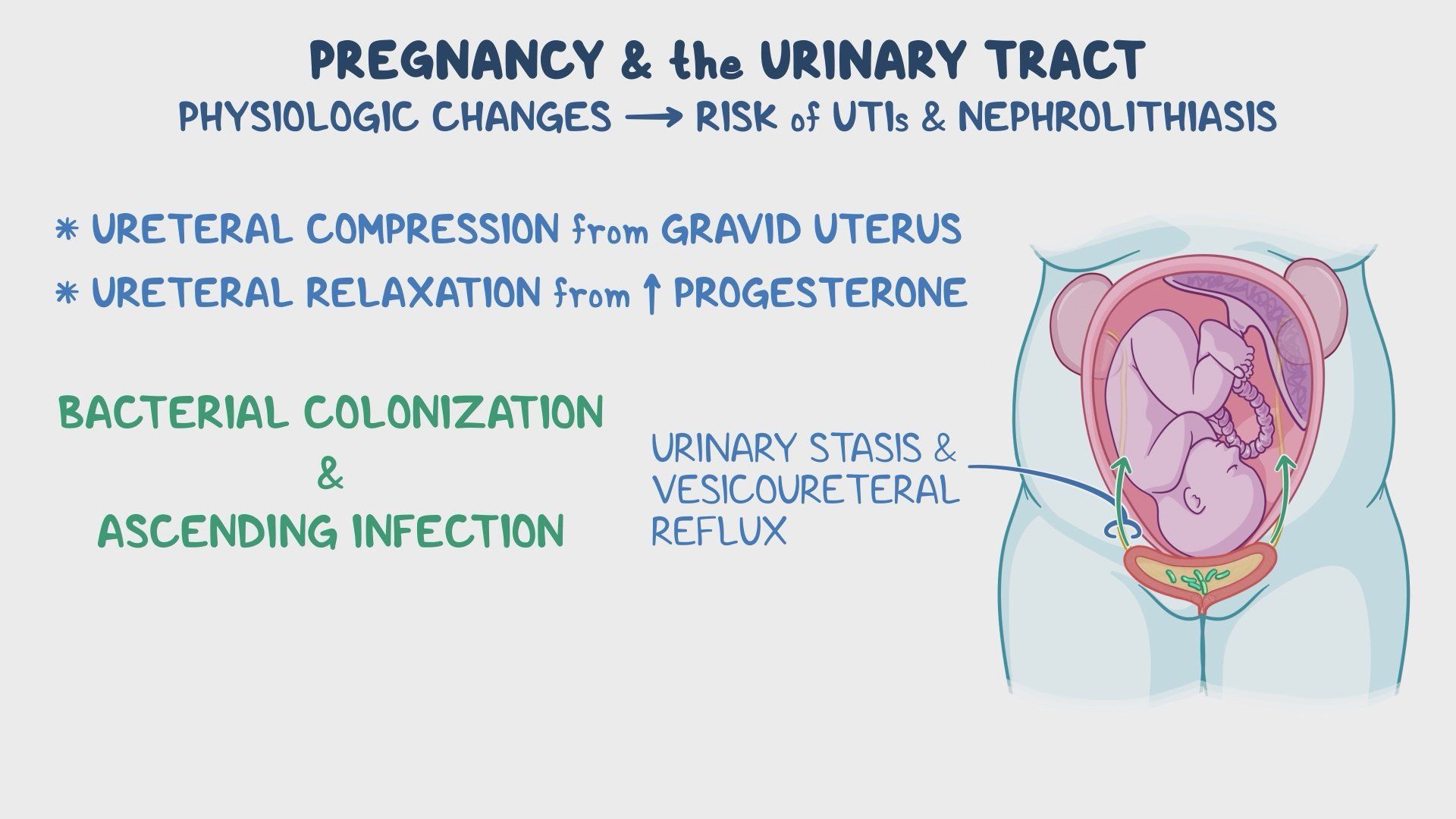 Video: Urinary tract infections and kidney stones in pregnancy ...