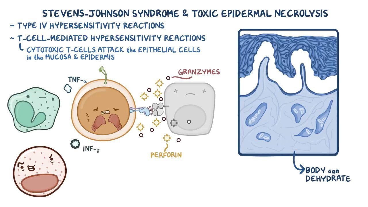 Video Stevens Johnson Syndrome Osmosis