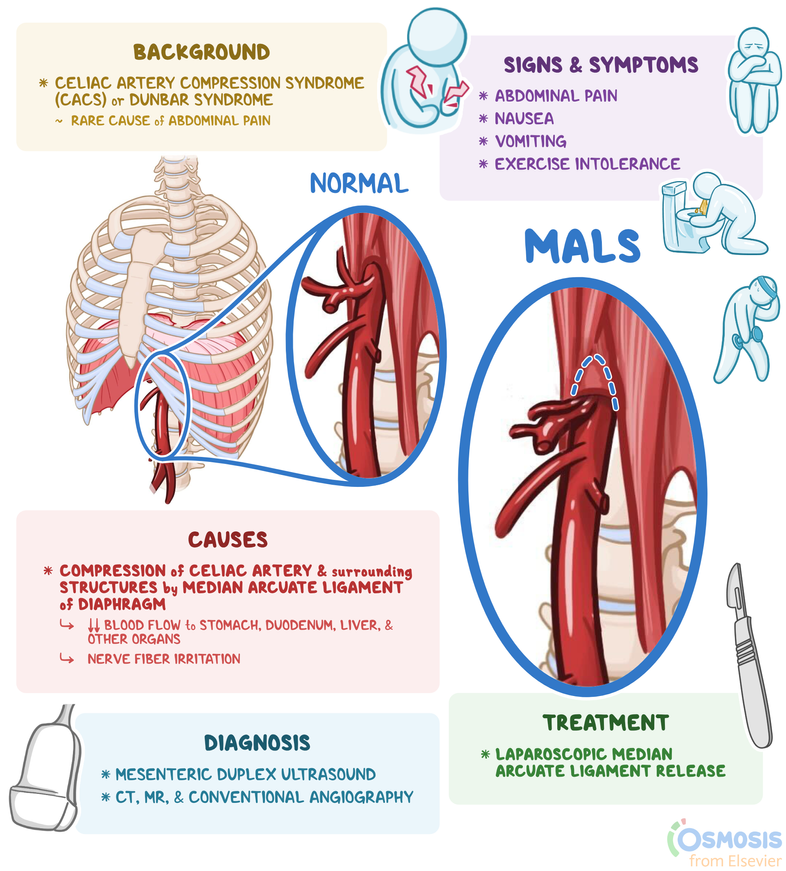 Median Arcuate Ligament Syndrome MALS What Is It Causes Symptoms 