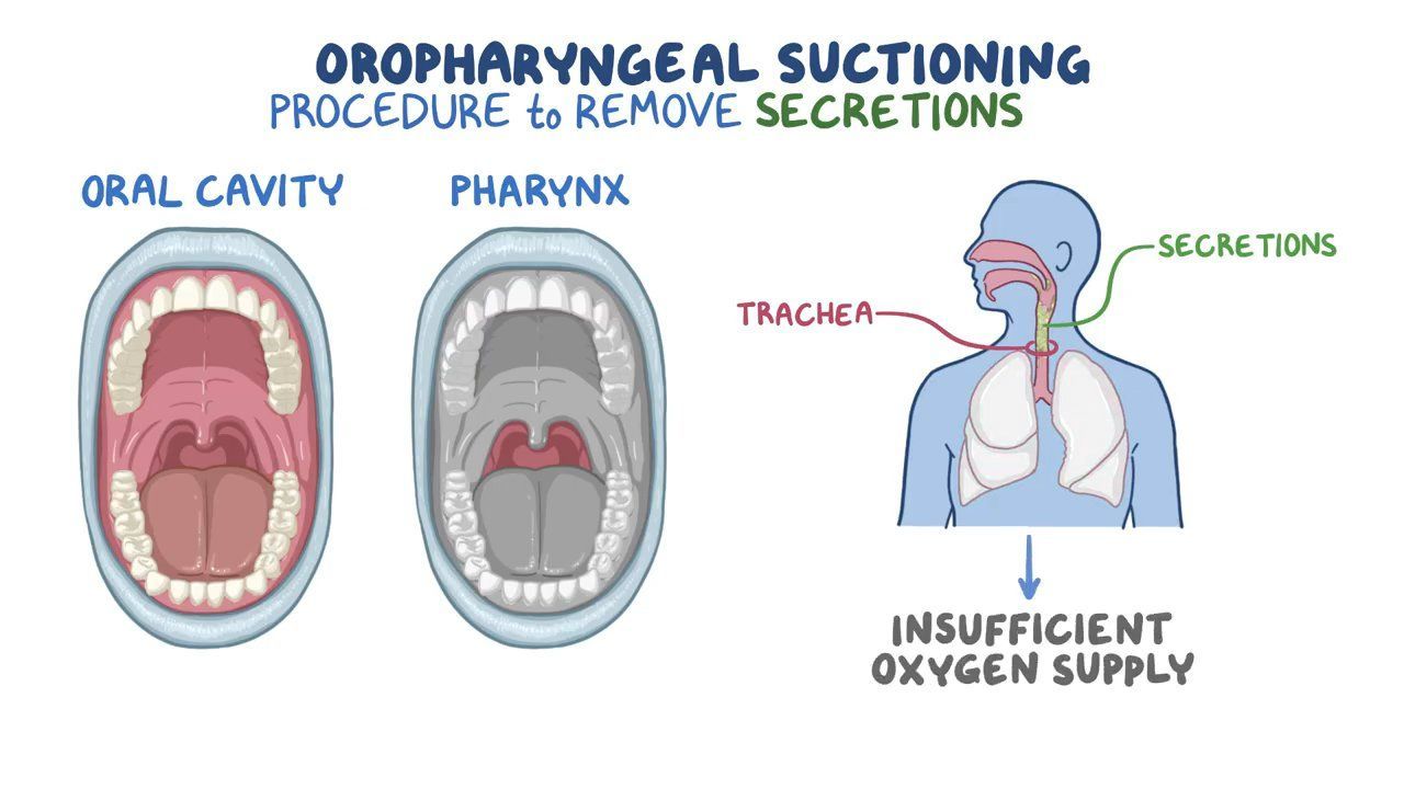 Oropharyngealnasopharyngeal Airway And Suction Fast