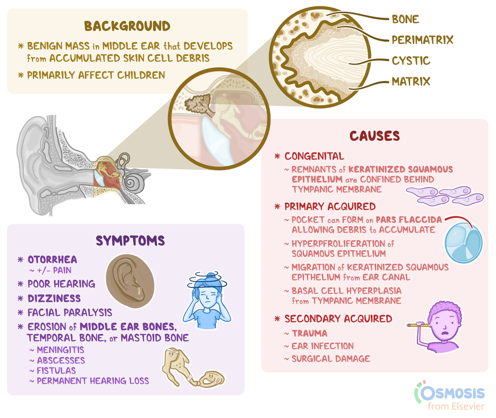 Cholesteatoma What It Is Causes Signs Symptoms Diagnosis Osmosis