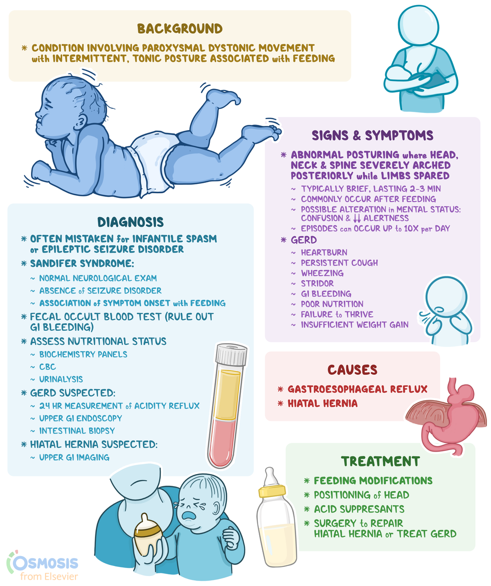 Sandifer Position Sandifer Syndrome: What Is It, Causes, Diagnosis, and More | Osmosis